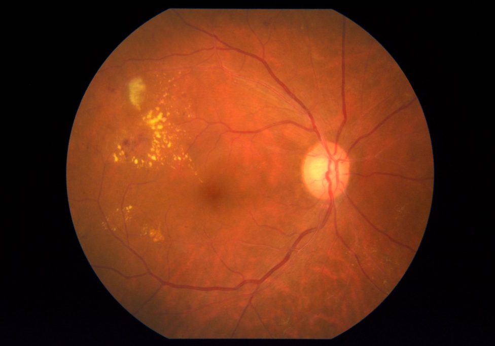 comprehensive eye Consultation - digital retinal imaging